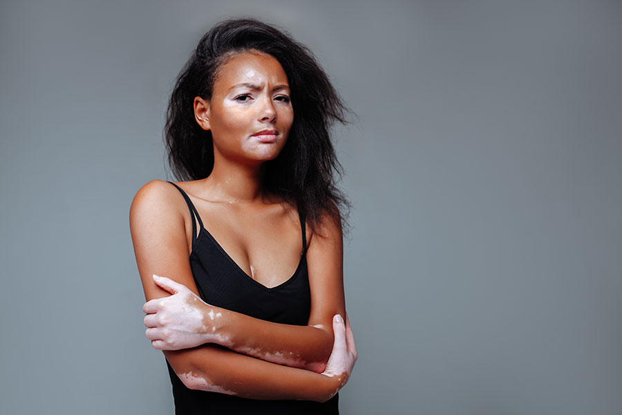 young-african-american-woman-with-vitiligo